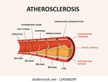 Atherosclerosis - plaque buildup.