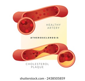 Aterosclerosis - Acumulación de placa - Ilustración de stock como EPS 10 Archivo