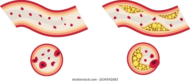 La aterosclerosis es una afección progresiva en la que la placa, compuesta de grasa, colesterol, calcio y otras sustancias, se acumula dentro de las arterias, lo que lleva a un estrechamiento y reducción del flujo sanguíneo