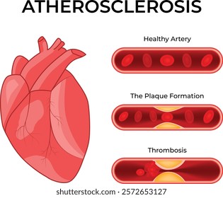 Atherosclerosis Science Design Vector Illustration Diagram