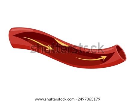Atherosclerosis stage. Anatomy of heart attack. Arteriosclerotic vascular disease or ASVD. Atherosclerotic plaque in coronary artery. Vector illustration on white background