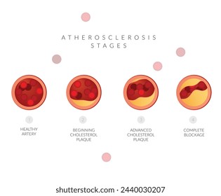 Etapas de la aterosclerosis - Acumulación de placa de colesterol - Ilustración de stock como archivo EPS 10