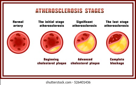 Atherosclerosis stages. Disturbance of lipid and protein metabolism, adjournment the cholesterol plaques in arteries.