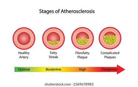 Atherosclerosis Stages, normal artery versus narrowed artery blocked with cholesterol plaque. Blood vessel blocked with a clot. High cholesterol level as atherosclerotic risk. Vector design.