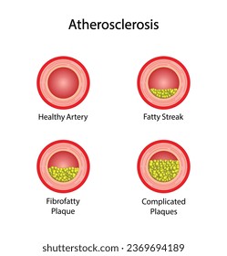 Atherosclerosis Stages, normal artery versus narrowed artery blocked with cholesterol plaque. Blood vessel blocked with a clot. High cholesterol level as atherosclerotic risk. Vector design.