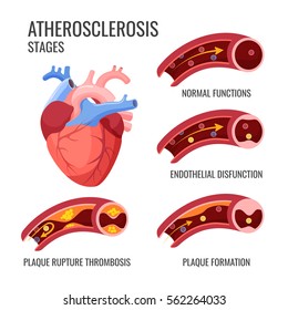 Atherosclerosis stages. Normal functions, endothelia disfunction, plaque formation, rupture thrombosis