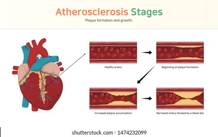 Atherosclerosis stages. Plaque formation and growth.