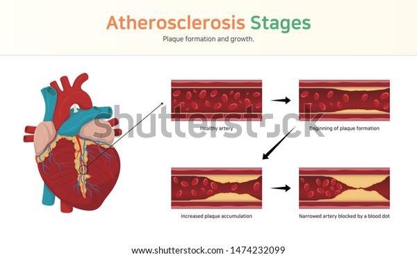 Atherosclerosis\
stages. Plaque formation and\
growth.
