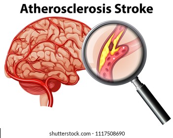 Atherosclerosis Stroke on White Background illustration