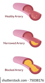 atherosclerosis with three kind of vein