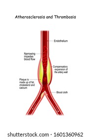 Atherosclerosis And Thrombosis. Thrombus Formation In A Blood Vessel. Vector Illustration For Medical Use