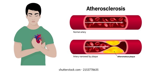 Atherosclerosis Vector Concept. The Difference Of Normal Artery And Artery Narrowed By Plaque. Coronary Artery Syndrome. Myocardial Ischemia.
