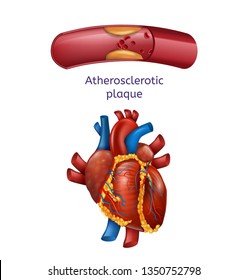 Presentación de la Ilustración del Vector de Placas ateroscleróticas. Flor de sangre en vasos a través de placas ateroscleróticas, cierre afiche de Anatomía Realista del Corazón. Concepto médico de atención médica