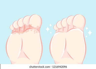 Athlete foot with peeling skin before and after treatment