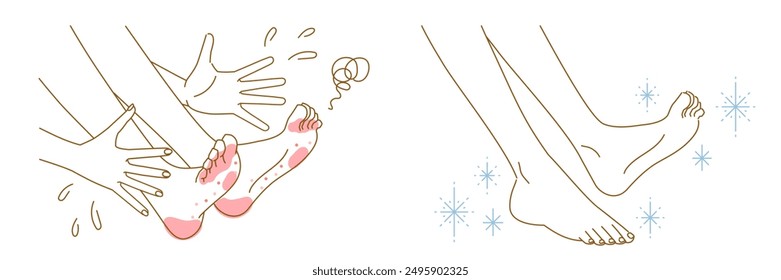 Athlete's foot, corns, calluses: illustration set of images of women's feet