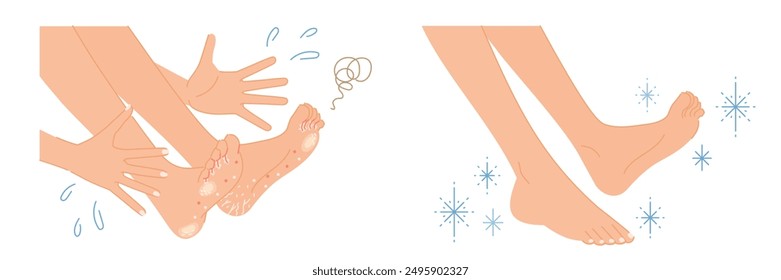 Athlete's foot, corns, calluses: illustration set of images of women's feet