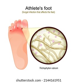 Athlete's foot is a fungal infection that affects the feet. sole of foot with parasitic fungus. Close-up of  Trichophyton rubrum Fertile Hyphae, Macroconidia and Microconidia. Vector illustration