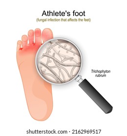 Athlete's foot. fungal infection that affects the feet. Close-up of Trichophyton rubrum fungi. vector illustration