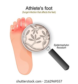 Athlete's foot. fungal infection that affects the feet. Close-up of Epidermophyton floccosum fungi. vector illustration - Shutterstock ID 2162969557