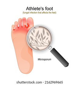 Athlete's foot. fungal infection that affects the feet. Close-up of Microsporum fungi. vector illustration