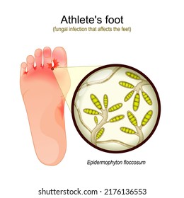 Athlete's foot. fungal infection that affects the feet. Close-up of yeast that causes infection disease of skin. Epidermophyton floccosum. vector illustration