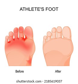 Athlete's foot is a fungal infection that affects the feet. Comparison and difference. Humans feet before and after therapy. vector poster