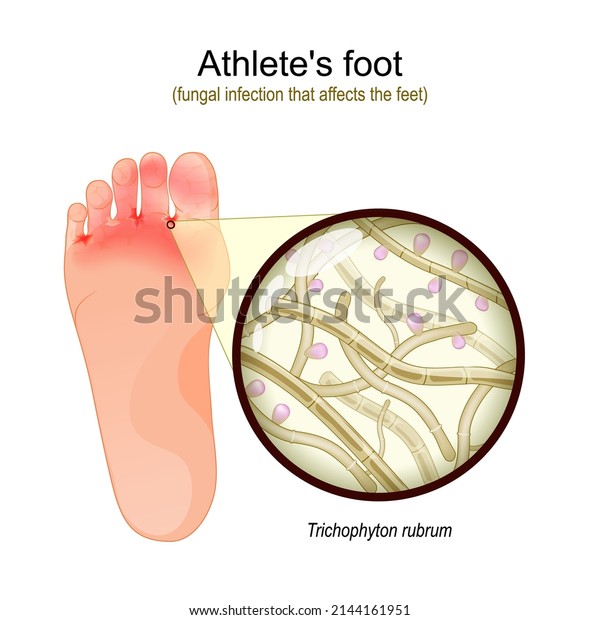 Athlete\'s foot is a fungal infection that\
affects the feet. sole of foot with parasitic fungus. Close-up of \
Trichophyton rubrum Fertile Hyphae, Macroconidia and Microconidia.\
Vector illustration