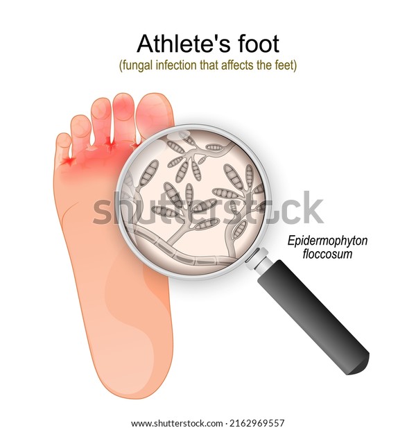 Athlete\'s foot. fungal infection that\
affects the feet. Close-up of Epidermophyton floccosum fungi.\
vector illustration