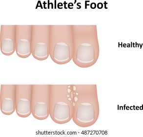 Athlete's Foot Illustration