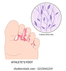 Athlete's foot Itchiness and jock itch symptom pus fungus bacteria toe smell bad