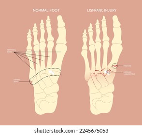 Athletes foot painful with density scan of displaced bone heel toes trauma and Chopart's five