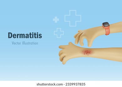 Dermatitis, alergia y problemas médicos cutáneos. Rascando mano en el brazo picante. Atención médica y de salud. Caricatura vectorial 3D.