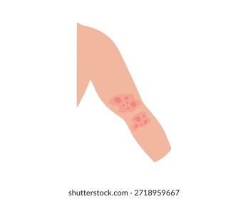 Dermatitis atópica en los codos