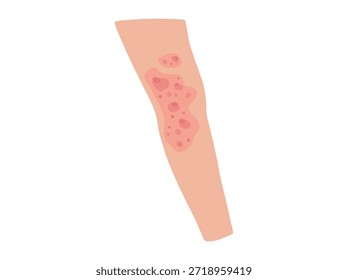 Dermatitis atópica en las rodillas