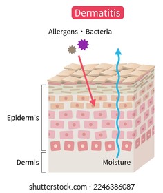 atopic dermatitis dry skin skin cell layer. eczema disrupt moisture barrier that allows penetrate external stimuli. Healthy and beauty skin care concept