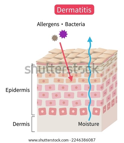 atopic dermatitis dry skin skin cell layer. eczema disrupt moisture barrier that allows penetrate external stimuli. Healthy and beauty skin care concept