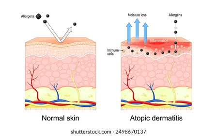 Dermatitis atópica. Eccema. Sección transversal de la piel normal e inflamación de la piel seca. Ilustración vectorial