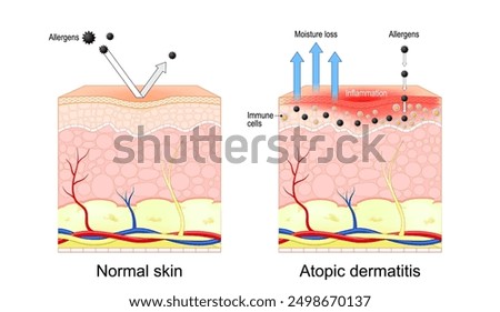 Atopic dermatitis. Eczema. Cross-section of normal skin and Dry skin inflammation. Vector illustration