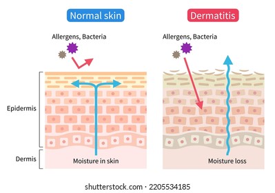 dermatitis atópica (eczema), sequedad e ilustración celular normal de la piel. Concepto de cuidado de la piel saludable y de belleza