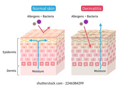 atopic dermatitis (eczema) dry and normal skin cell layer illustration. Healthy and beauty skin care concept - Shutterstock ID 2246384299