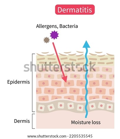 atopic dermatitis (eczema) dry skin disrupt moisture barrier that allows penetrate external stimuli. Healthy skin care concept