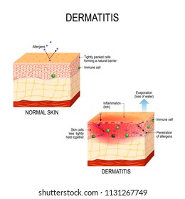 Atopic dermatitis (atopic eczema). Healthy skin and cross-section of human skin with dermatitis. showing changes and differences. Vector illustration for medical and educational use