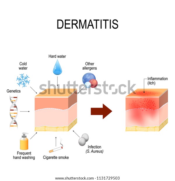 Atopic Dermatitis Atopic Eczema Healthy Skin Stock Vector (Royalty Free ...