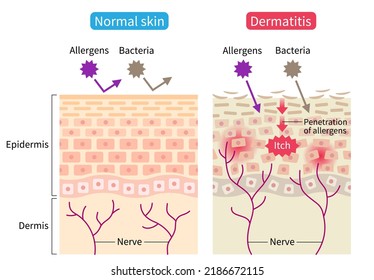 Atopic Dermatitis Eczema Normal Skin Cell Stock Vector (Royalty Free ...