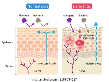 atopic dermatitis (eczema) and normal skin cell illustration. Healthy skin care concept