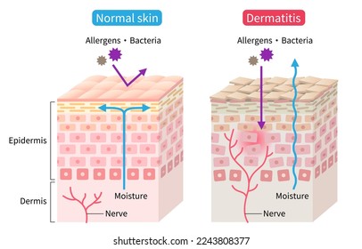 atopic dermatitis (eczema) and normal skin cell layer illustration. Healthy skin care concept