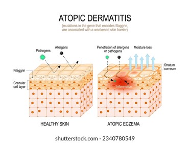 Atopic dermatitis. Filaggrin and atopic eczema. mutations in the gene that encodes filaggrin, are associated with a weakened skin barrier. Close-up of cells of Stratum corneum with filament