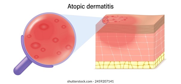 Atopic dermatitis symptoms vector. Close-up of skin cells with eczema. 