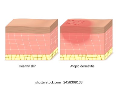 Vektorgrafik von Symptomen einer atopischen Dermatitis. Querschnitt der menschlichen Haut mit Ekzemen. Vergleich zwischen gesunder Haut und atopischer Dermatitis.