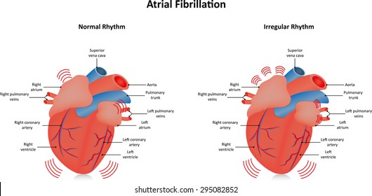 Atrial Fibrillation